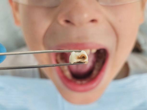 Best Cracked Tooth Emergency Dentist  in Winlock, WA